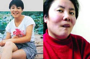 女童突然脱发眼神呆滞 查出铊中毒